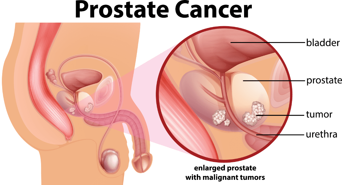Prostate Cancer Illustrative Diagram