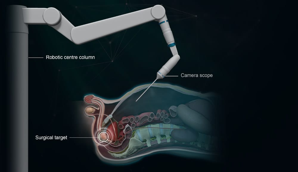 Robotic Prostatectomy Surgery Procedure Illustration